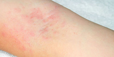 psoriasis_bg