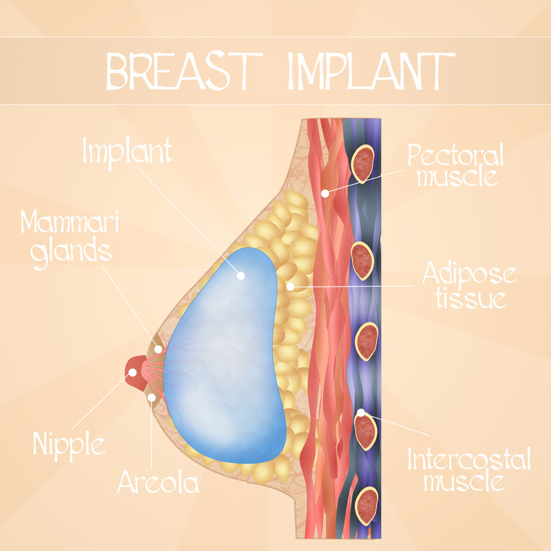 Anatomy of a Breast - How Breast Implants Work